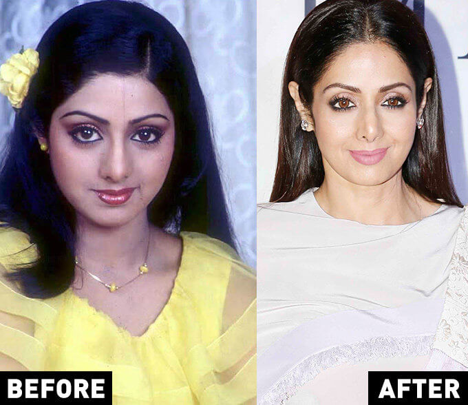 Bollywood stars you would’ve never guessed use Botox