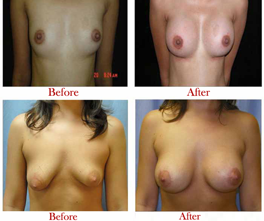 Everything about Breast Augmentation & Breast Implant Surgery