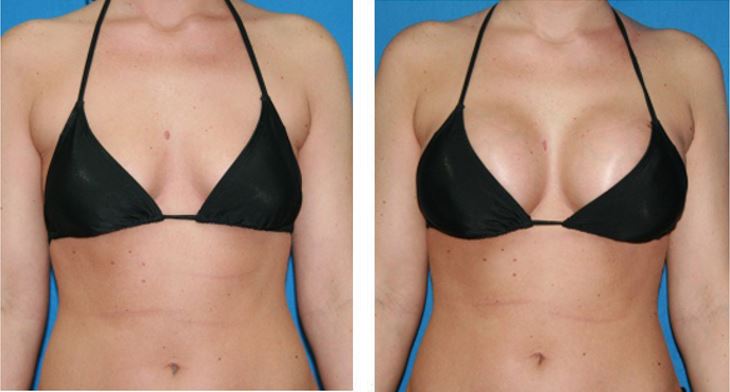 Breast Augmentation & Breast Implant Surgery