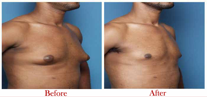 Details about Male Breast reduction surgery in Delhi