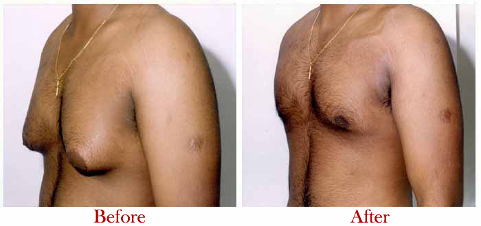Easy and Effective Male Breast Reduction Treatment is not as Difficult as You Think