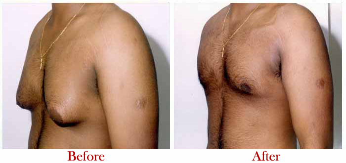 Male Chest Reduction - Gynecomastia Surgery, Men Boobs Lipo London