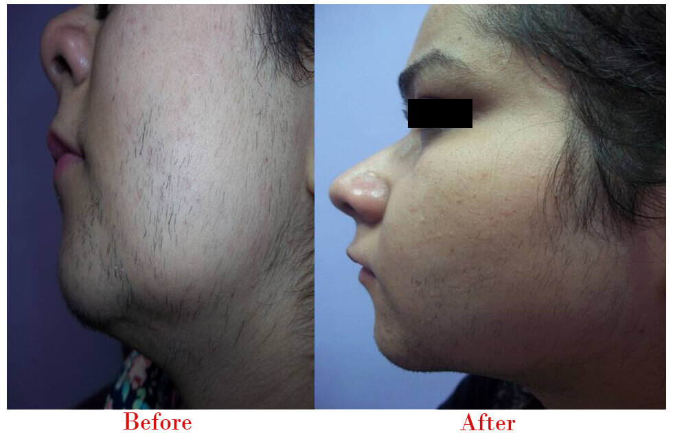 Now instantly transform your skin with the Best Skin Laser Treatment in Delhi