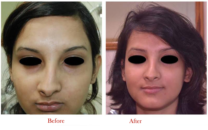 Rhinoplasty surgery doesn’t have to be hard or painful. Read these valuable tips.