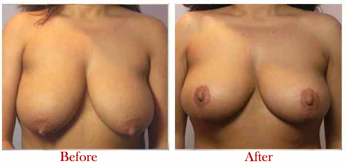The Five Secrets That You Should Know About Breast Reduction Surgery
