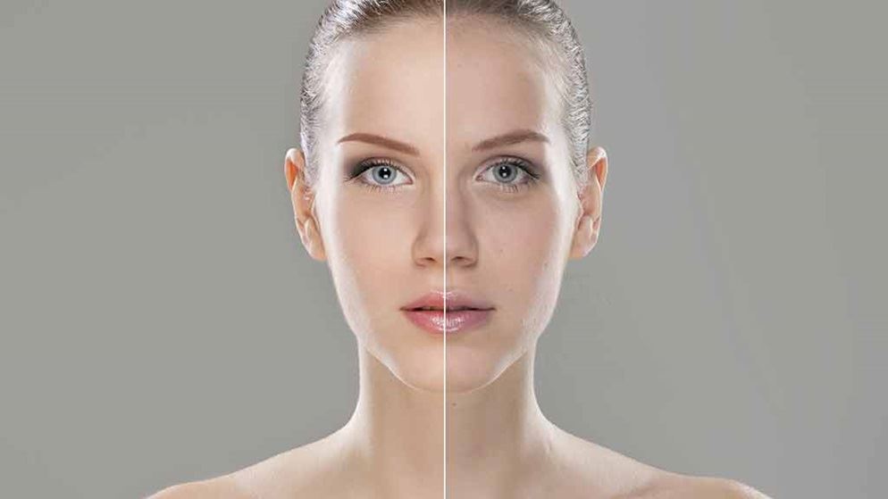 The good and the bad of Botox