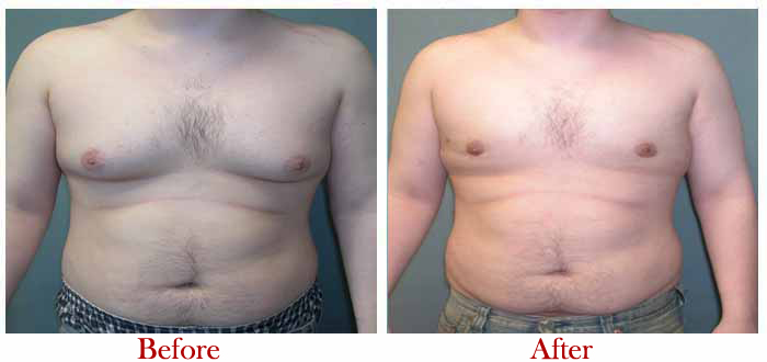 Things to know before going for male breast reduction in Delhi