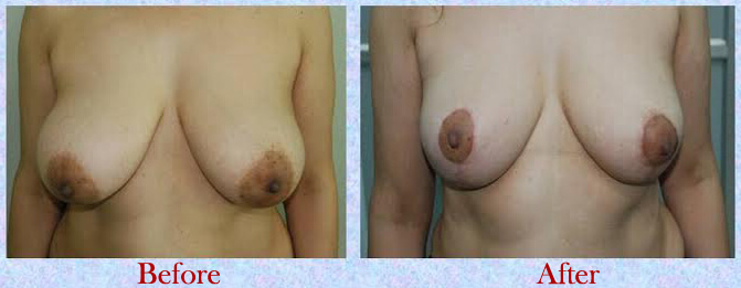 Understand What a Breast Lift Surgery Is