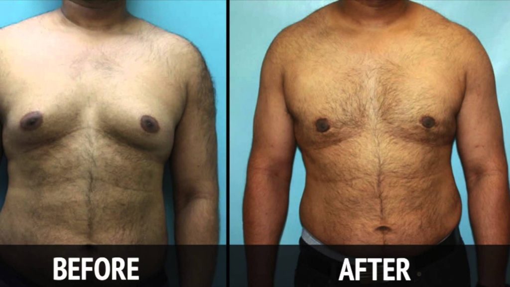 Ways to make Male Breast Reduction Treatment even Better