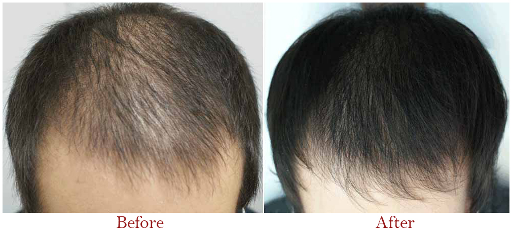 What is the success rate of hair transplant surgery?