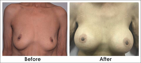 Why Breast Lift Surgery Is Common Now A Days?