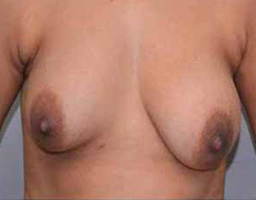 Breast Augmentation By Fat Grafting