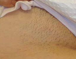 Best laser hair removal in Delhi
