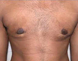 Male Breast Reduction