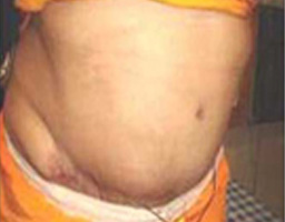 Tummy Tuck Surgery in Chandigarh