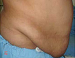 Tummy Tuck Surgery in Delhi