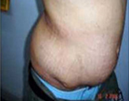 Tummy Tuck Surgery in Chandigarh